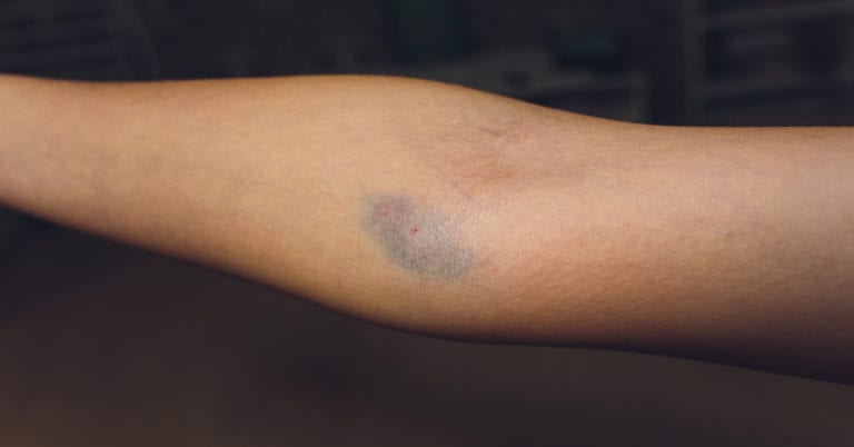 How to Get Rid of Bruises from Intravenous Drug Use? | Evoke Waltham